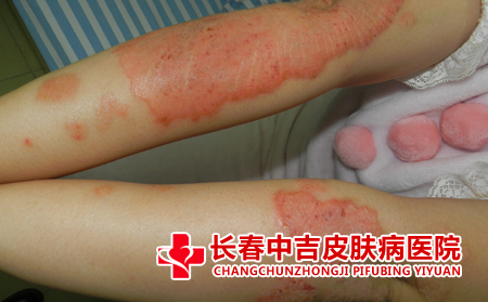 鱼鳞病的症状有什么