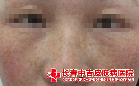 黄褐斑的预防方式