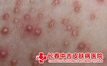 毛囊炎要怎样去治比较不错