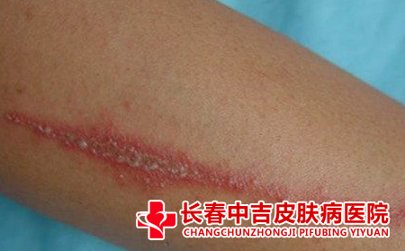 皮炎该怎么护理,皮炎的护理怎么做