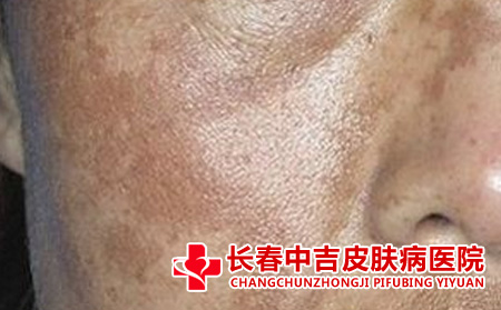 黄褐斑对患者的危害