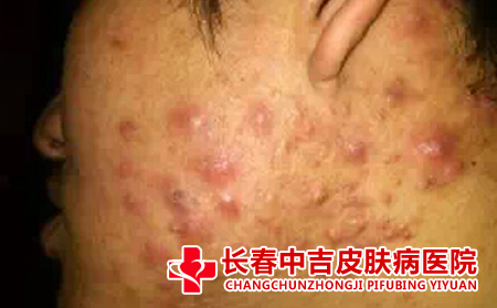 痤疮患者如何洗脸比较不错