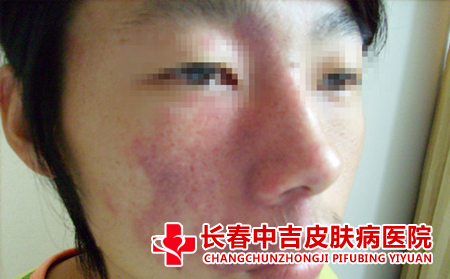胎记对女性患者的危害大不大