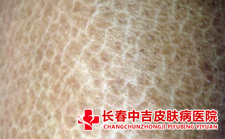得了鱼鳞病有什么症状表现