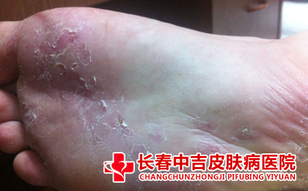 脚癣怎么护理,如何护理脚癣