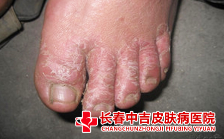 脚癣的病因是什么