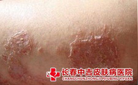 皮炎治疗时需要注意的