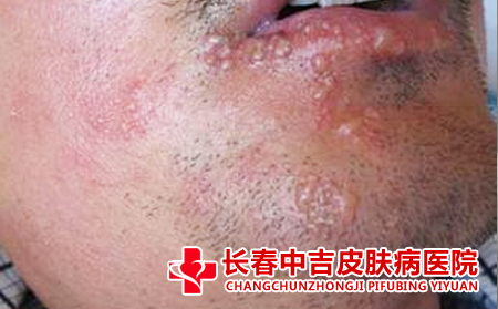 复发性疱疹如何去进行治疗合适