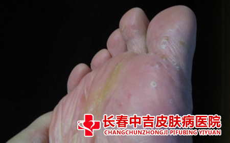 脚癣怎么护理