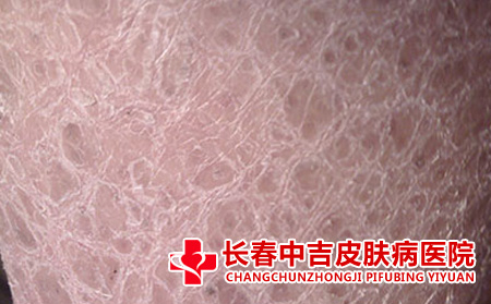 鱼鳞病治疗费用
