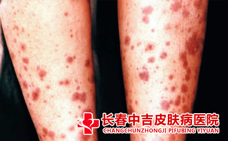患上红斑狼疮护理方法有什么