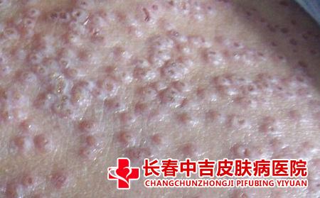 长春湿疹治疗费用