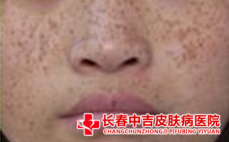 面部有雀斑要怎样去治疗合适