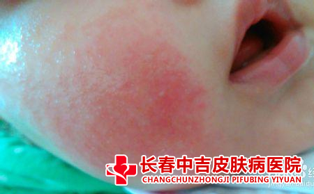 湿疹的症状是什么,湿疹有哪些症状