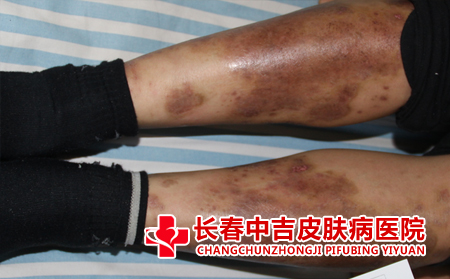 皮炎的护理方式有什么