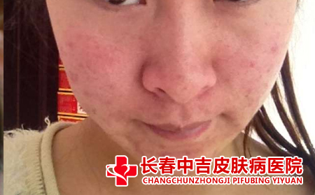 痤疮有什么治疗方法