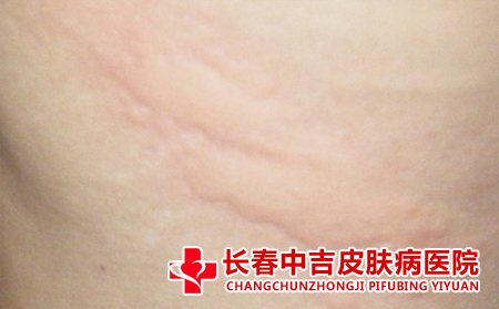 长春荨麻疹治疗医院的治疗费用是多少