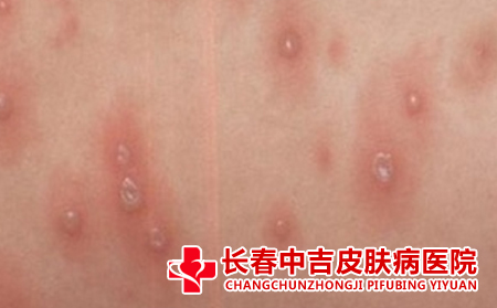 减轻荨麻疹的瘙痒应该怎么做