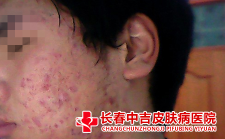皮肤上长痤疮的原因有哪些