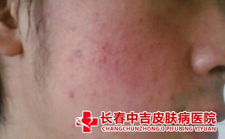 对痤疮要怎样进行规范的治疗