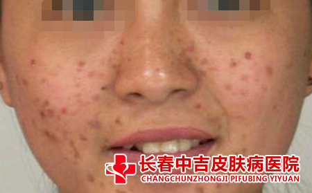 雀斑患者不能吃哪些食物