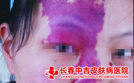 胎记治疗要注意什么