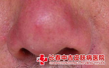 为什么我的酒糟鼻一直治不合适