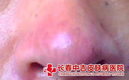 鼻子上有酒糟鼻要怎样去护理