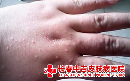 长春扁平疣治疗方法