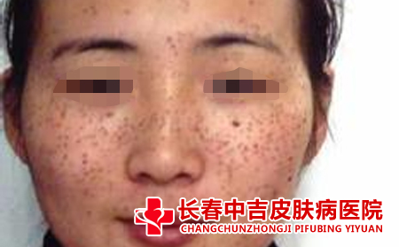 护理雀斑的方法