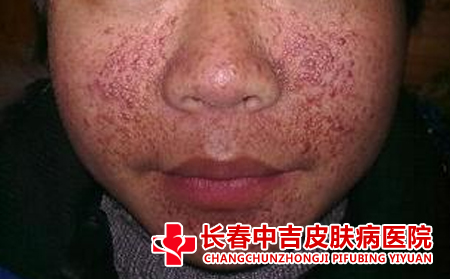 脸上的痤疮要怎样去治疗比较不错