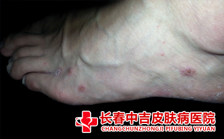 容易感染脚气的场所是什么