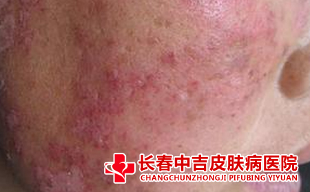 长春红斑狼疮治疗费用