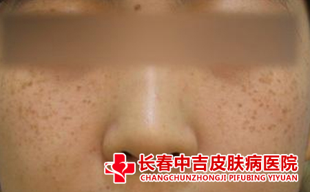 女儿脸上开始长雀斑的原因