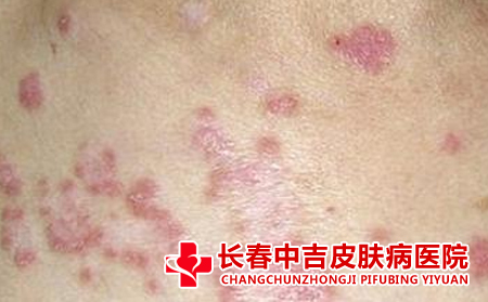 什么是寒冷性荨麻疹啊