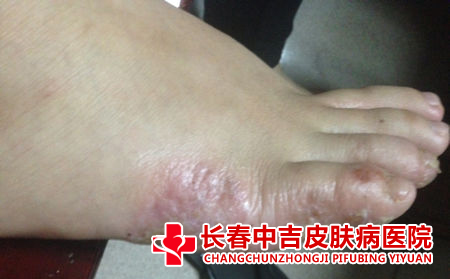 脚气患者夏季穿凉鞋合适吗