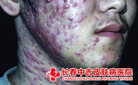 脸上的痤疮一直消退不了怎么办