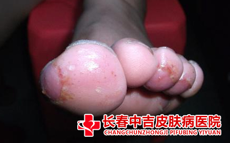脚气患者夏季怎么护理