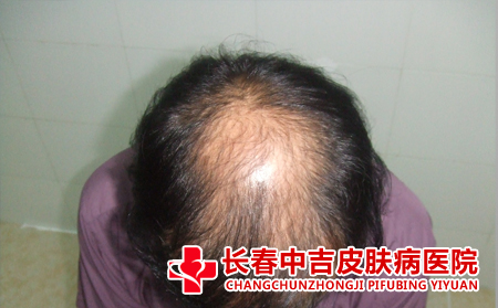 脱发怎么护理