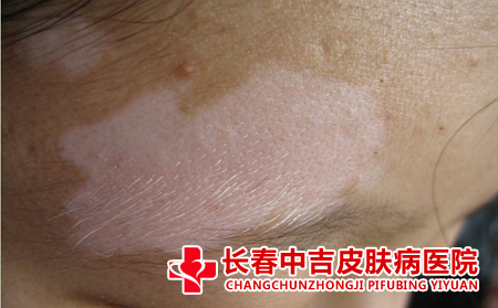 护理局限性白癜风患者应该怎么做