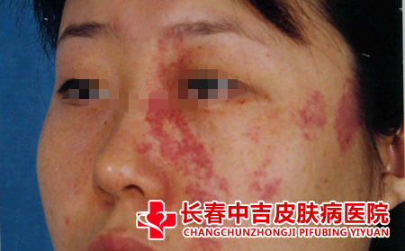 用激光治胎记会不会有副作用