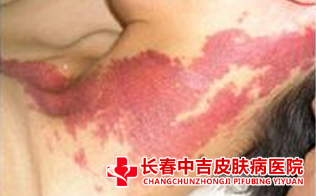 皮肤上有红胎记要 怎样护理合适呢
