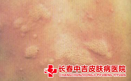 什么食物荨麻疹患者不吃比较不错