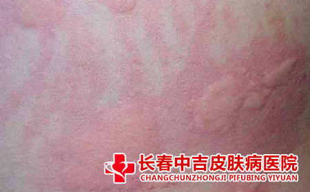 荨麻疹患者应该怎么护理自己