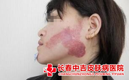 鲜红斑痣的的颜色有什么特点