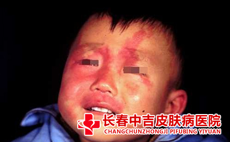 治疗鲜红斑痣要注意什么