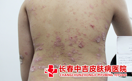体癣的护理方法是什么
