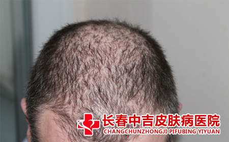 导致脱发的原因是什么
