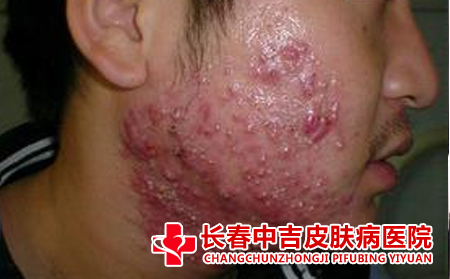 预防痤疮要注意哪些细节