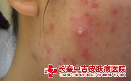 如何护理痤疮患者比较不错